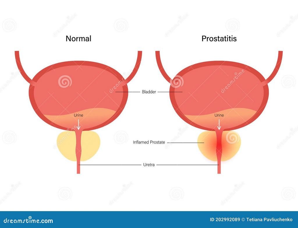Uno de los enfoques más eficaces para tratar la prostatitis
